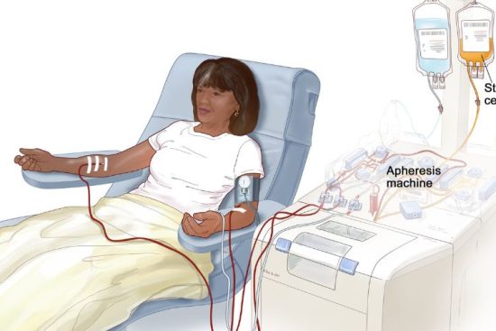 Apheresis Market