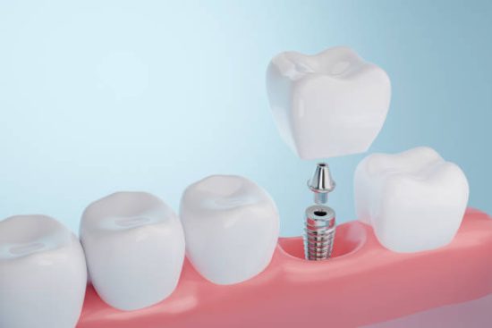 dental implants