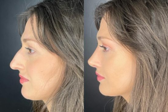 ultrasonic-rhinoplasty-rizni-lik