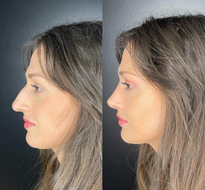 ultrasonic-rhinoplasty-rizni-lik